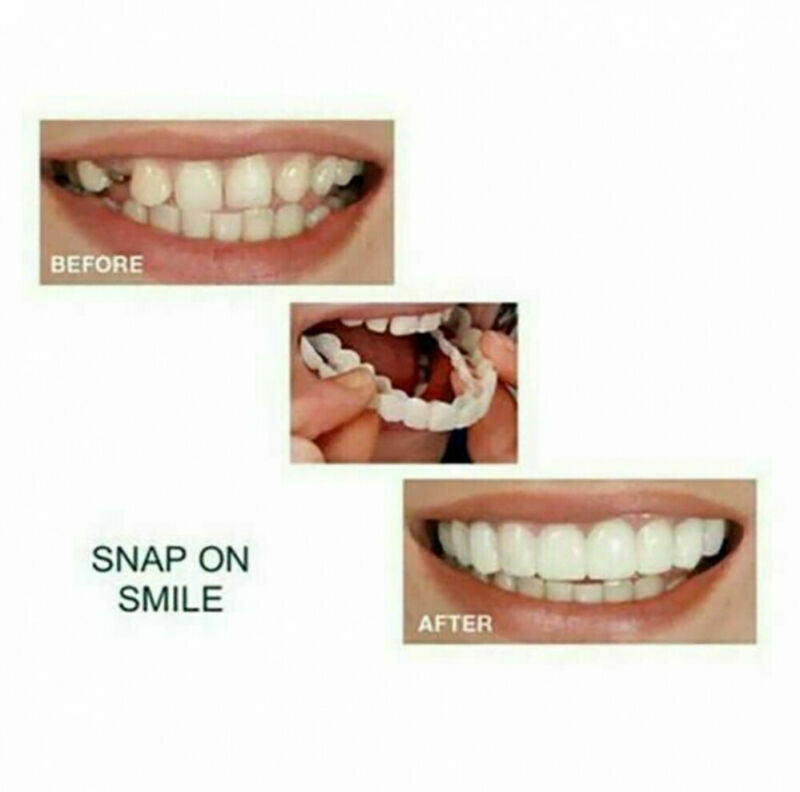 Snap On Dental Veneers