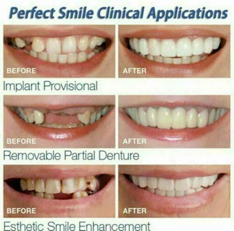 Snap On Dental Veneers
